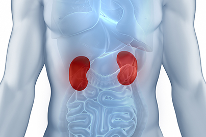 Kidney Stones 