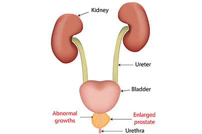 enlarged prostate forums retenție urinară la bărbați tratament