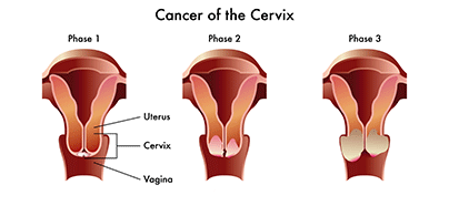 Illustration of Cancer of the Cervix